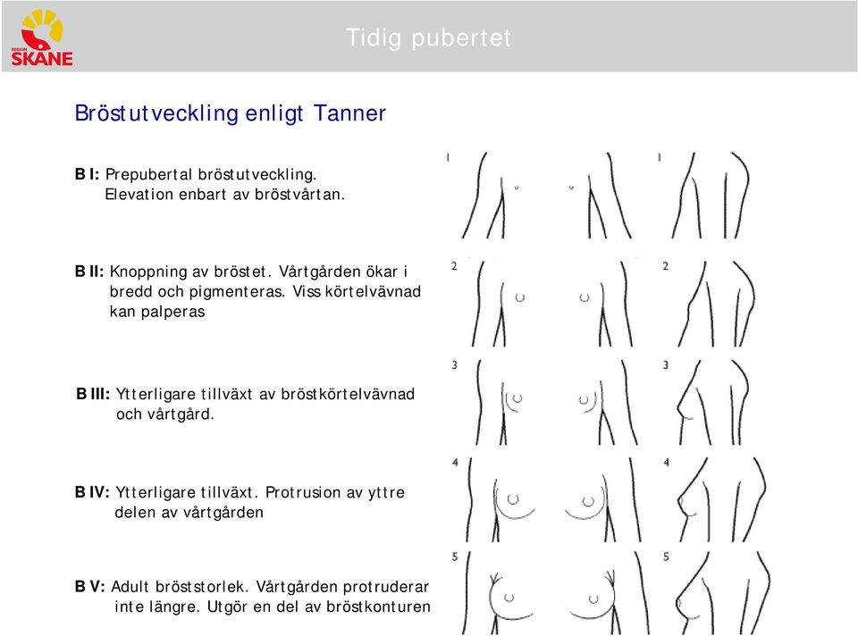 Viss körtelvävnad kan palperas B III: Ytterligare tillväxt av bröstkörtelvävnad ch vårtgård.