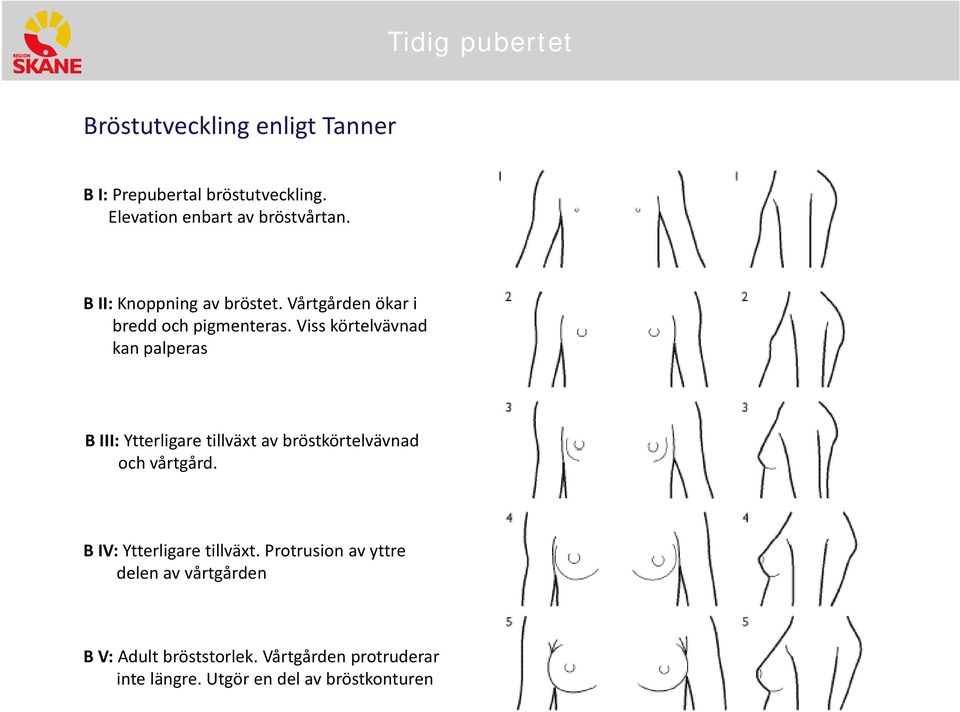 Viss körtelvävnad kan palperas B III: Ytterligare tillväxt av bröstkörtelvävnad och vårtgård.