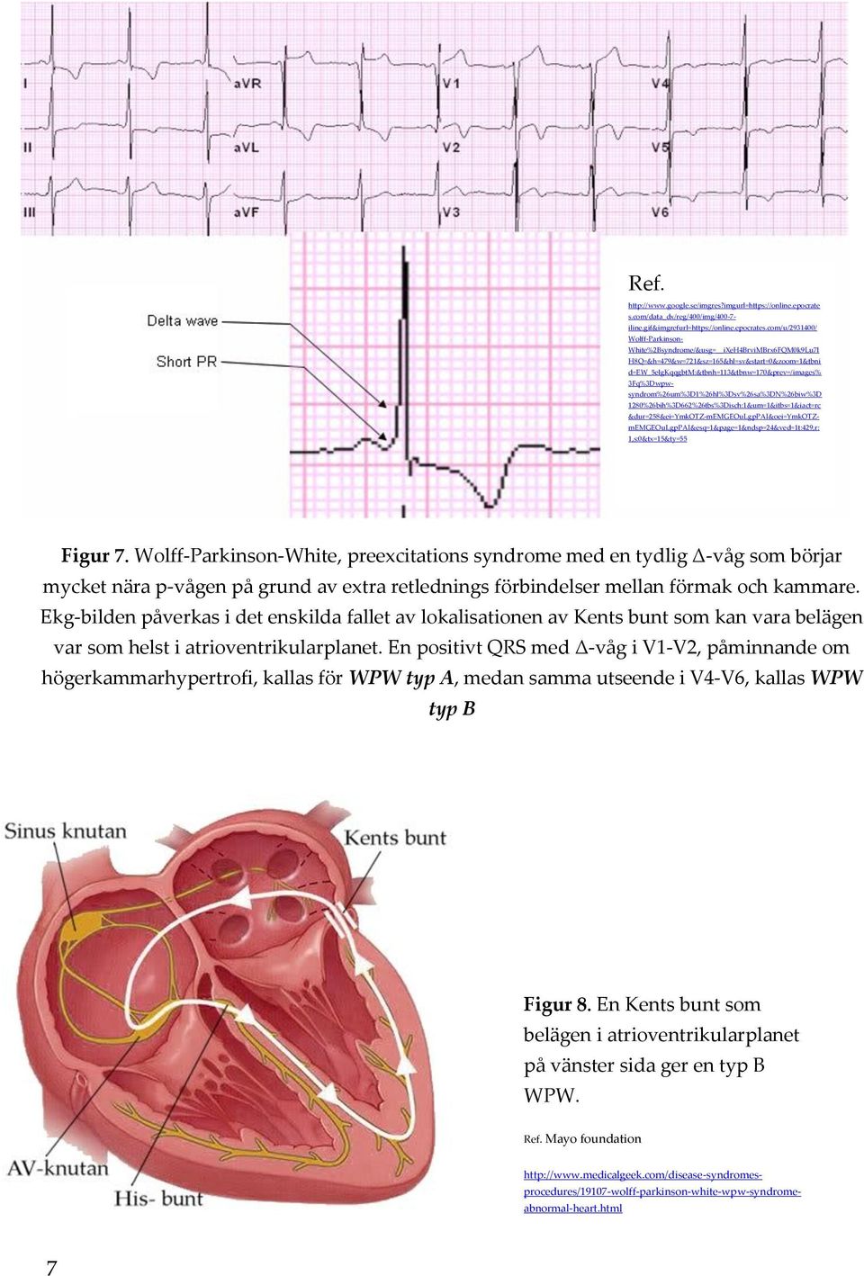 3Fq%3Dwpwsyndrom%26um%3D1%26hl%3Dsv%26sa%3DN%26biw%3D 1280%26bih%3D662%26tbs%3Disch:1&um=1&itbs=1&iact=rc &dur=258&ei=ymkotz-memgeoulgppai&oei=ymkotzmemgeoulgppai&esq=1&page=1&ndsp=24&ved=1t:429,r: