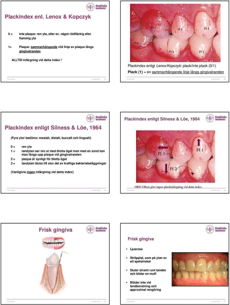 Plackindex enligt Lenox/Kopczyk: plack/inte plack (0/1) Plack (1) = en sammanhängande linje längs gingivalranden Lena Karlsson 14 oktober 2013 20 Plackindex enligt Silness & Löe, 1964 Plackindex