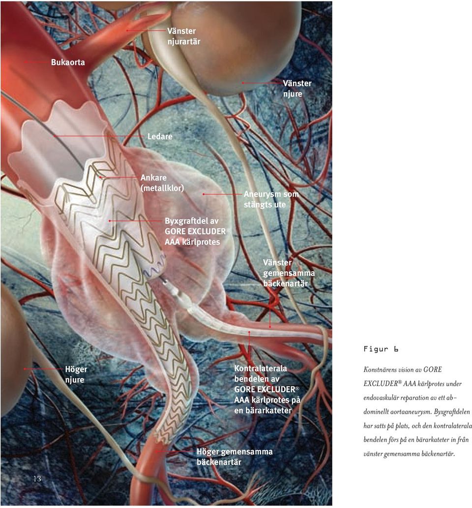 gemensamma bäckenartär Figur 6 Konstnärens vision av GORE EXCLUDER AAA kärlprotes under endovaskulär reparation av ett abdominellt