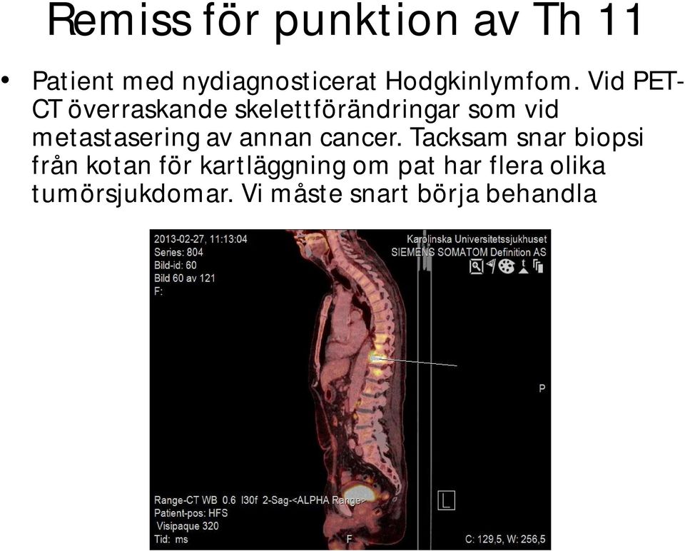 Vid PET- CT överraskande skelettförändringar som vid metastasering