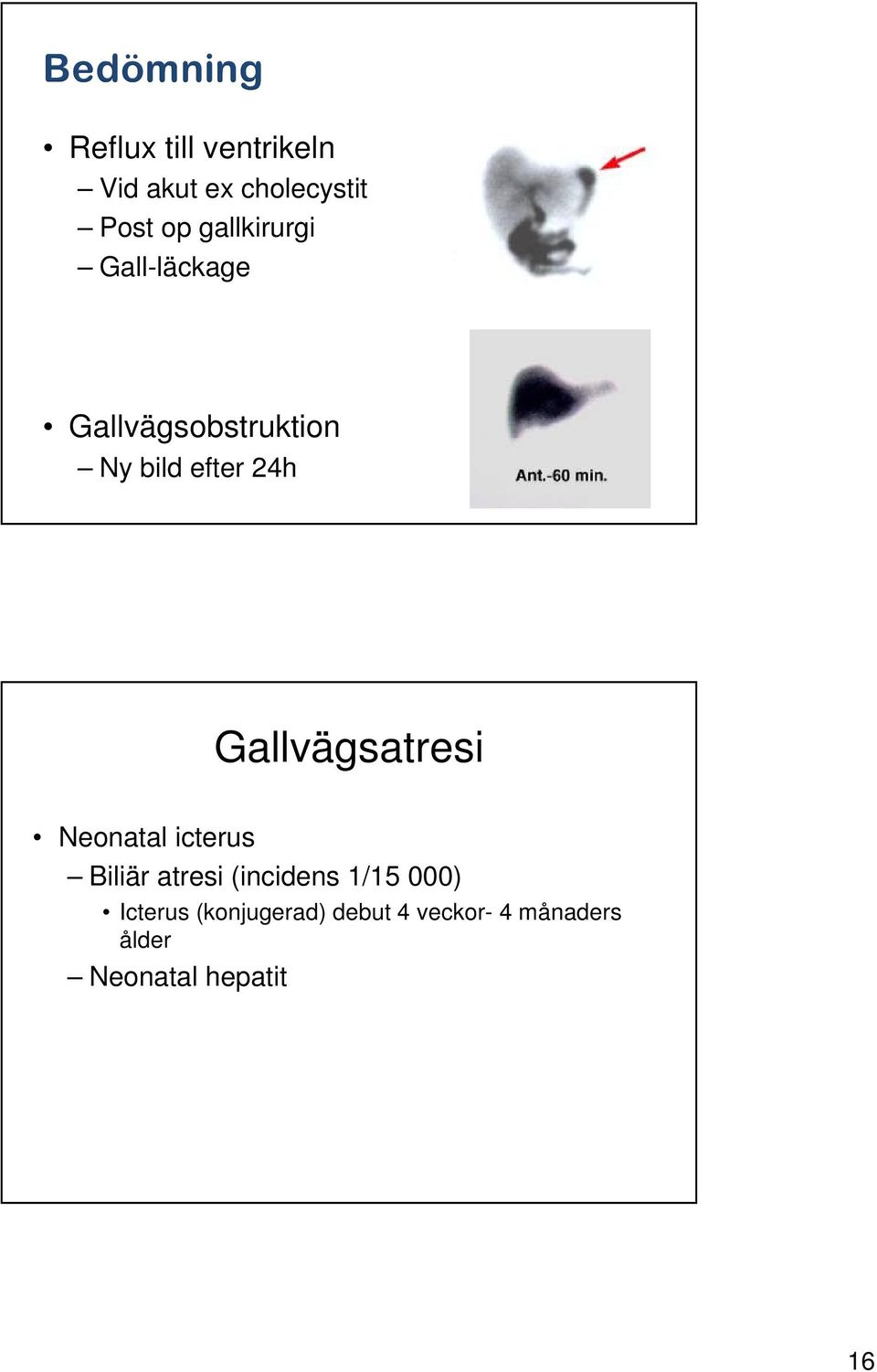 Gallvägsatresi Neonatal icterus Biliär atresi (incidens 1/15