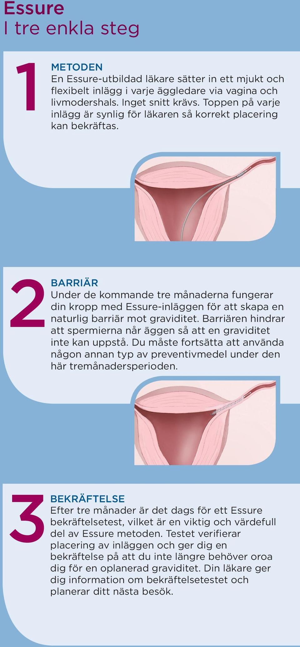 2Barriär Under de kommande tre månaderna fungerar din kropp med Essure-inläggen för att skapa en naturlig barriär mot graviditet.