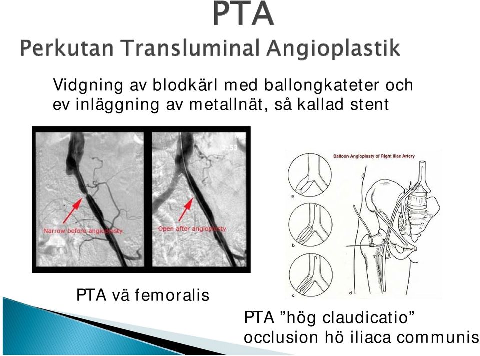 metallnät, så kallad stent PTA vä