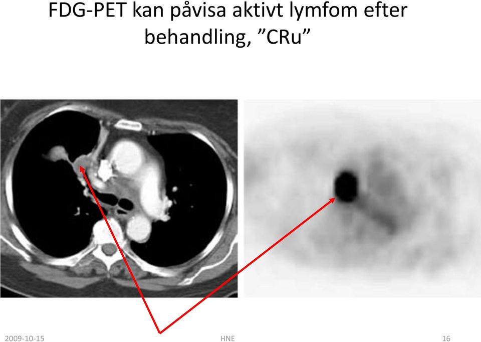 lymfom efter