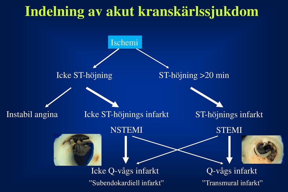 ST-höjnings infarkt NSTEMI ST-höjnings infarkt STEMI Icke