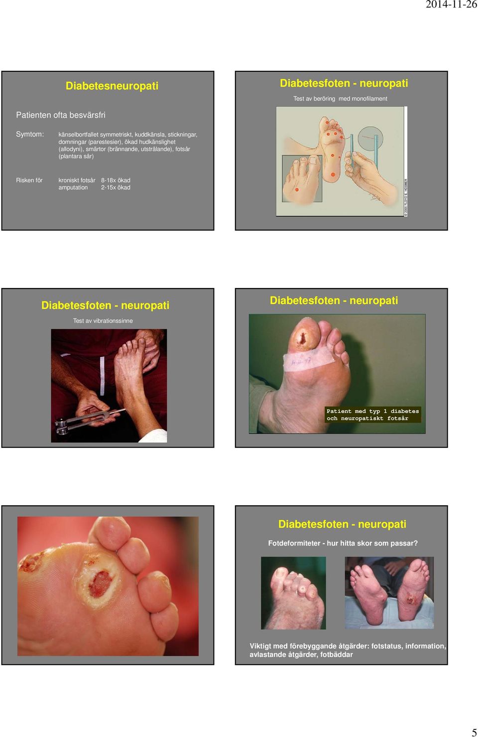 Risken för kroniskt fotsår 8-18x ökad amputation 2-15x ökad Test av vibrationssinne Patient med typ 1 diabetes och neuropatiskt