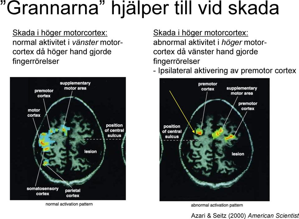 motorcortex: abnormal aktivitet i höger motorcortex då vänster hand gjorde