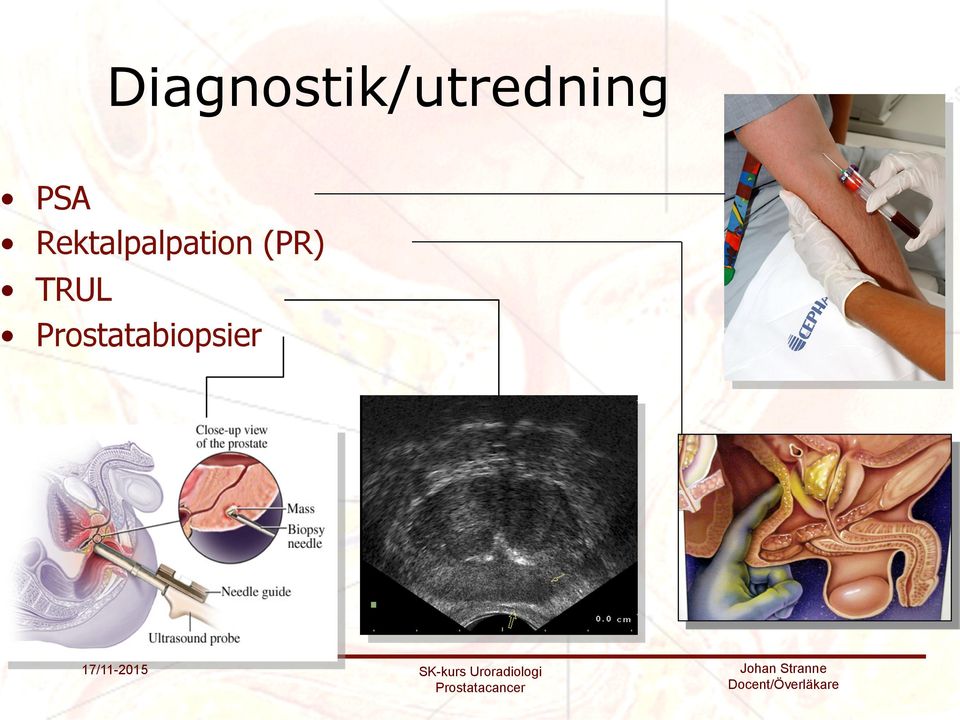 TRUL Prostatabiopsier