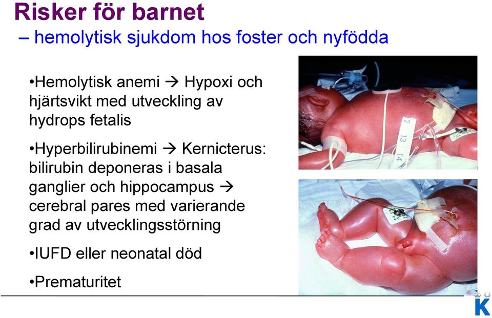 Kernicterus: bilirubin deponeras i basala ganglier och hippocampus cerebral