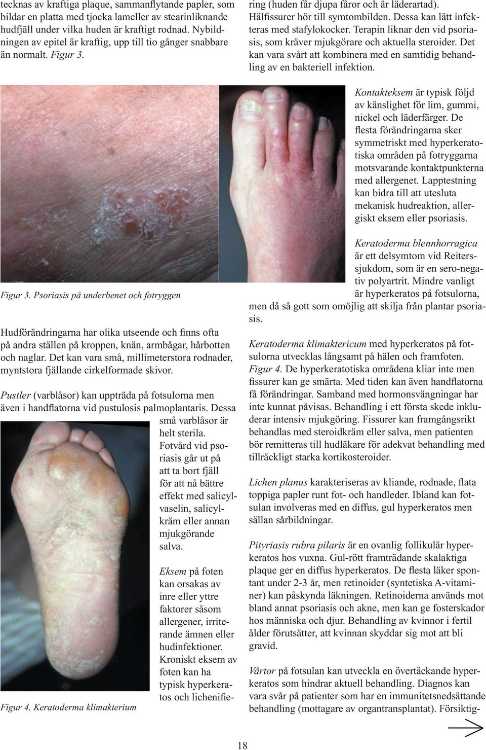 Kroniskt eksem av foten kan ha typisk hyperkeratos och lichenifiering (huden får djupa fåror och är läderartad). Hälfissurer hör till symtombilden. Dessa kan lätt infekteras med stafylokocker.