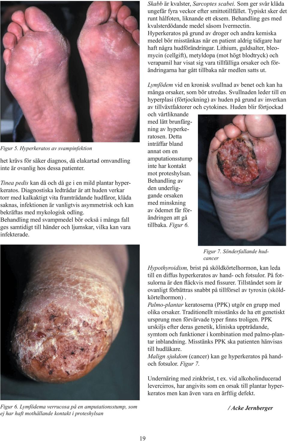 Lithium, guldsalter, bleomycin (cellgift), metyldopa (mot högt blodtryck) och verapamil har visat sig vara tillfälliga orsaker och förändringarna har gått tillbaka när medlen satts ut. Figur 5.