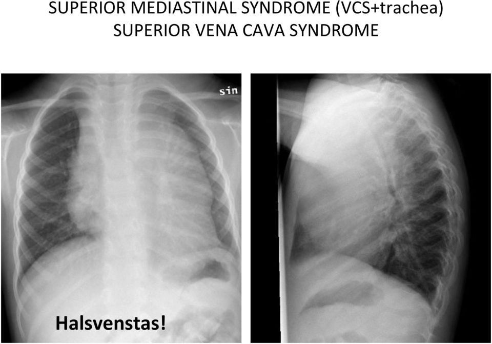 (VCS+trachea)