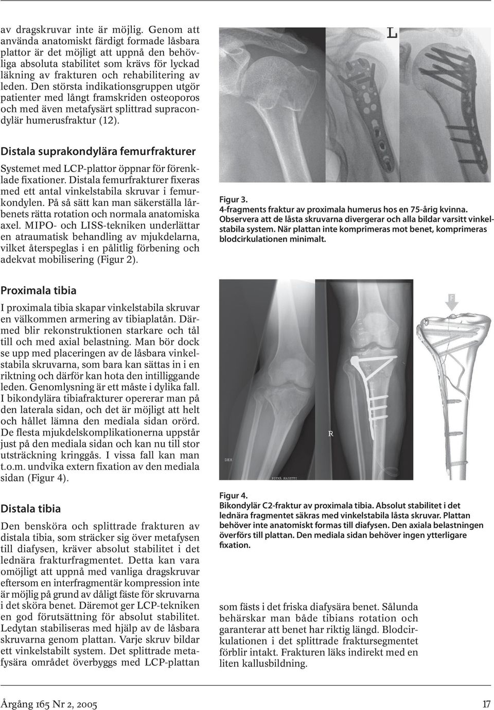 Den största indikationsgruppen utgör patienter med långt framskriden osteoporos och med även metafysärt splittrad supracondylär humerus fraktur (12).