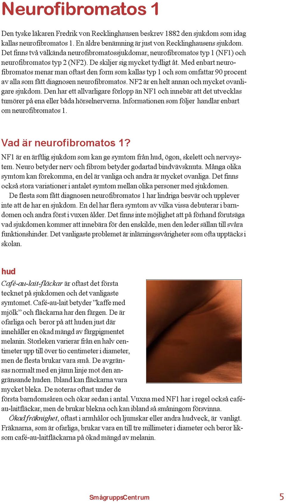 Med enbart neurofibromatos menar man oftast den form som kallas typ 1 och som omfattar 90 procent av alla som fått diagnosen neurofibromatos. NF2 är en helt annan och mycket ovanligare sjukdom.