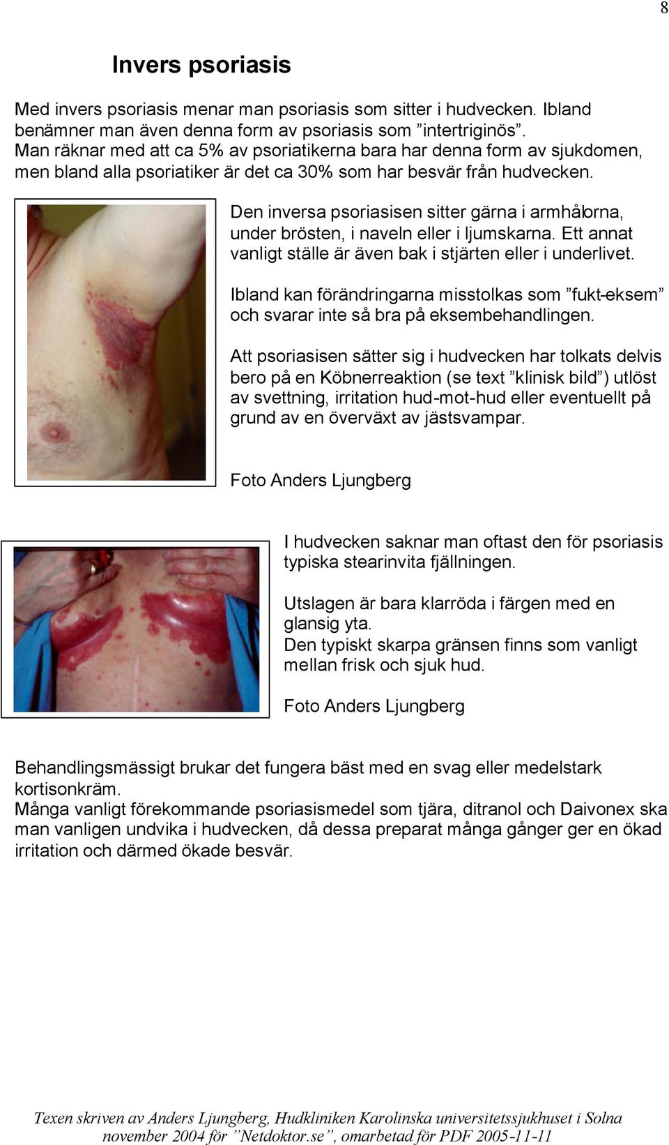 Den inversa psoriasisen sitter gärna i armhålorna, under brösten, i naveln eller i ljumskarna. Ett annat vanligt ställe är även bak i stjärten eller i underlivet.