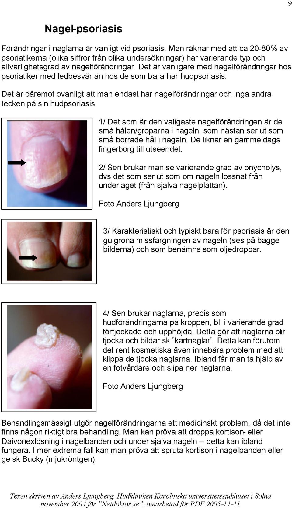 Det är vanligare med nagelförändringar hos psoriatiker med ledbesvär än hos de som bara har hudpsoriasis.