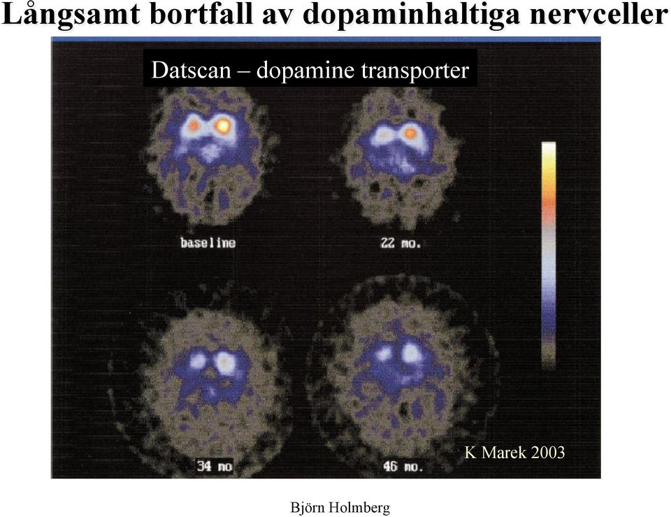 nervceller Datscan