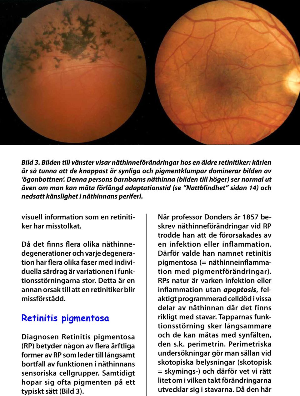 visuell information som en retinitiker har misstolkat.