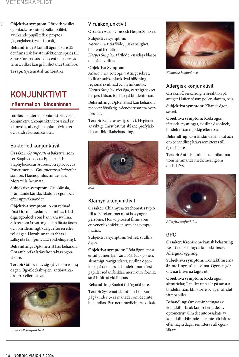 Terapi: Systematisk antibiotika KONJUNKTIVIT Inflammation i bindehinnan Indelas i bakteriell konjunktivit, viruskonjunktivit, konjunktivit orsakad av klamydia, allergisk konjunktivit, GPC och andra