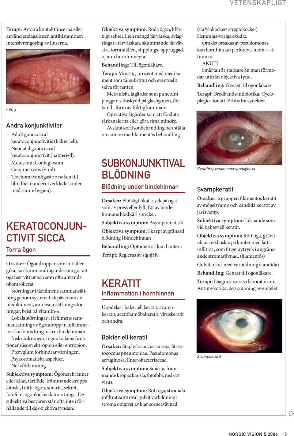 KERATOCONJUN- CTIVIT SICCA Torra ögon Orsaker: Ögondroppar som antiallergika, kärlsammandragande som gör att ögat ser vitt ut och som ofta används okontrollerat.