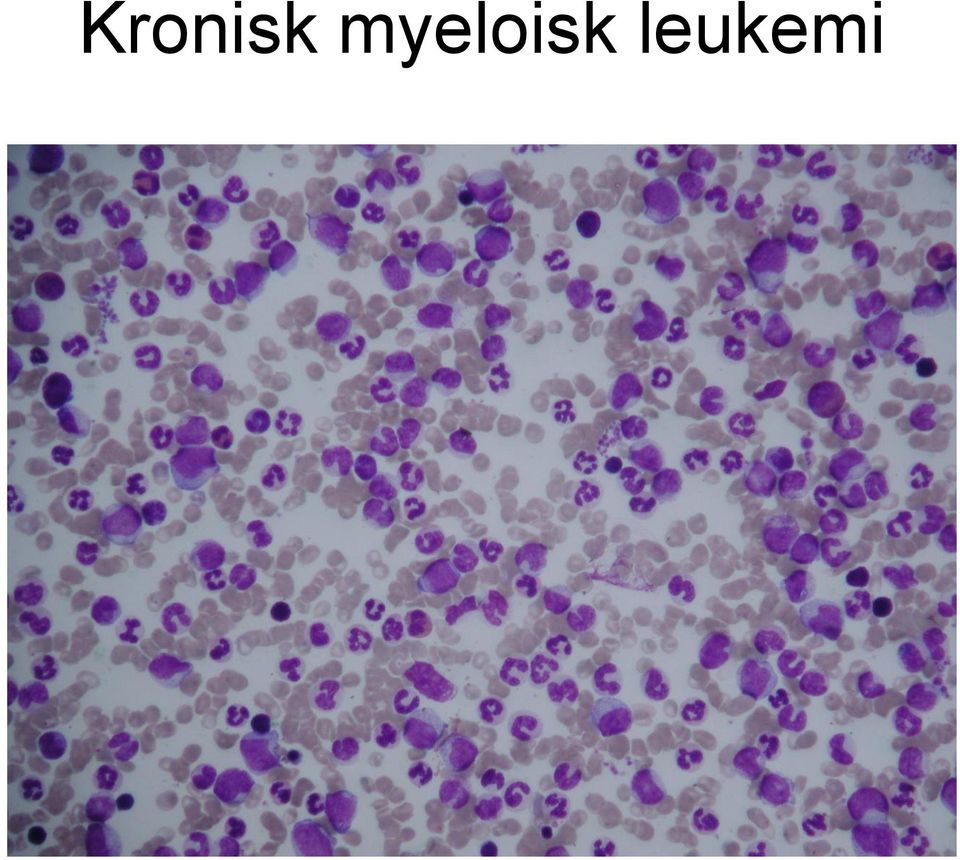 leukemi