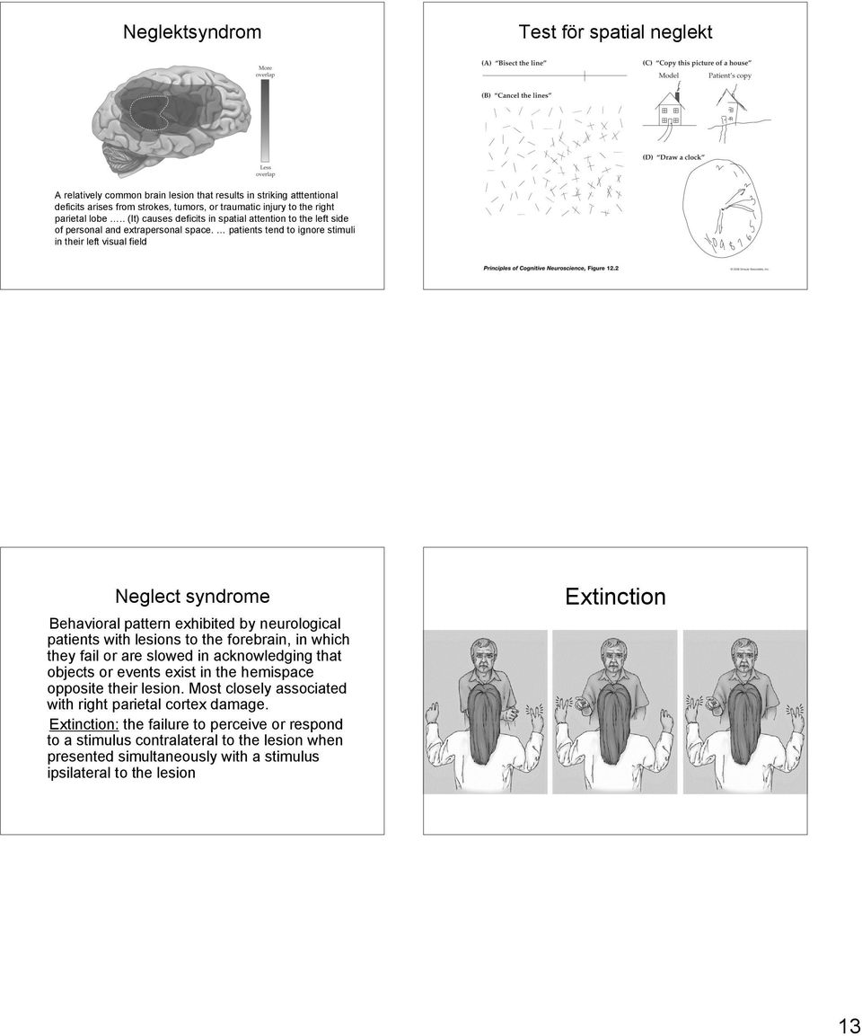 patients tend to ignore stimuli in their left visual field Neglect syndrome Behavioral pattern exhibited by neurological patients with lesions to the forebrain, in which they fail or are slowed in