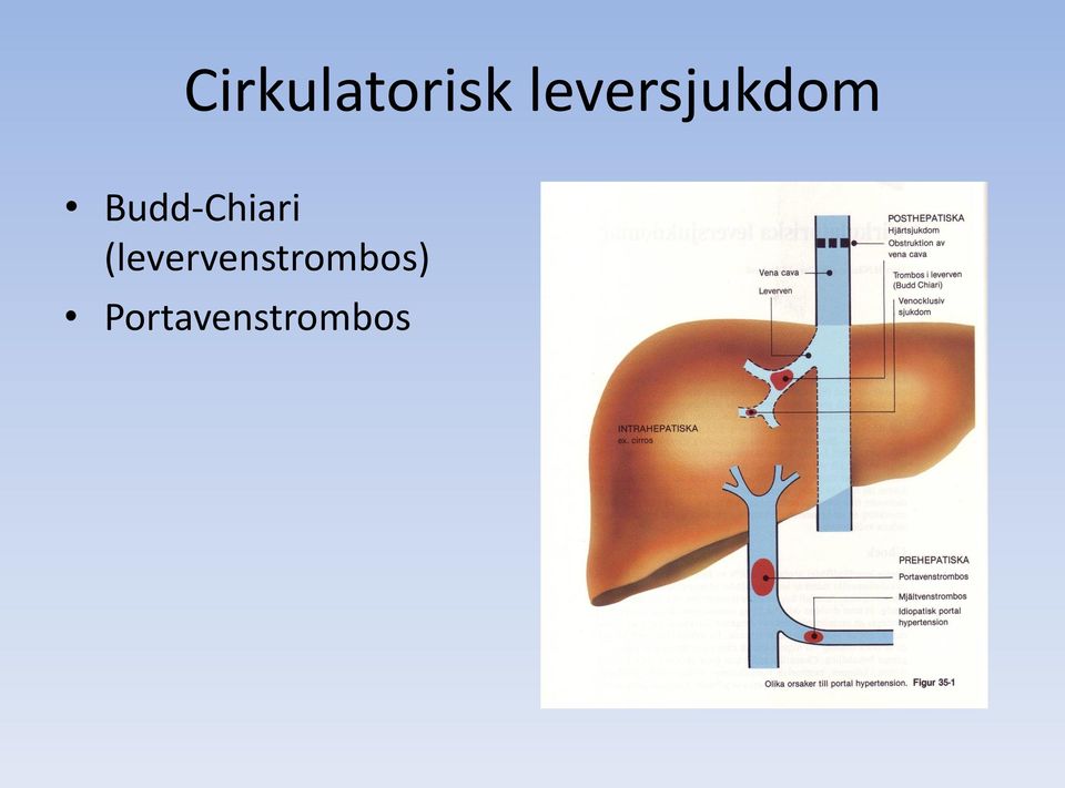 Budd-Chiari