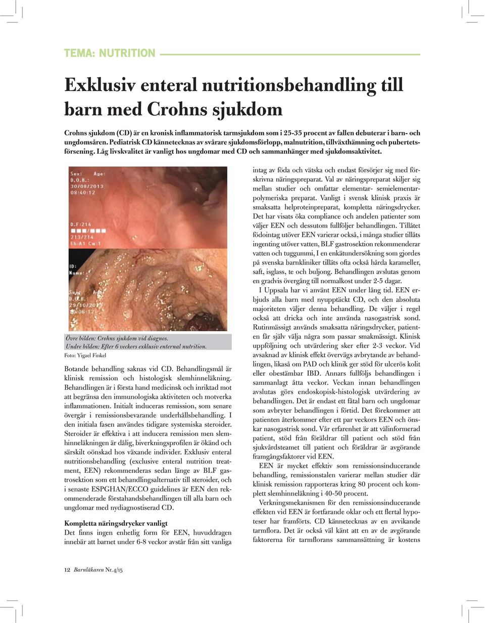 Låg livskvalitet är vanligt hos ungdomar med CD och sammanhänger med sjukdomsaktivitet. Övre bilden: Crohns sjukdom vid diagnos. Undre bilden: Efter 6 veckors exklusiv enternal nutrition.