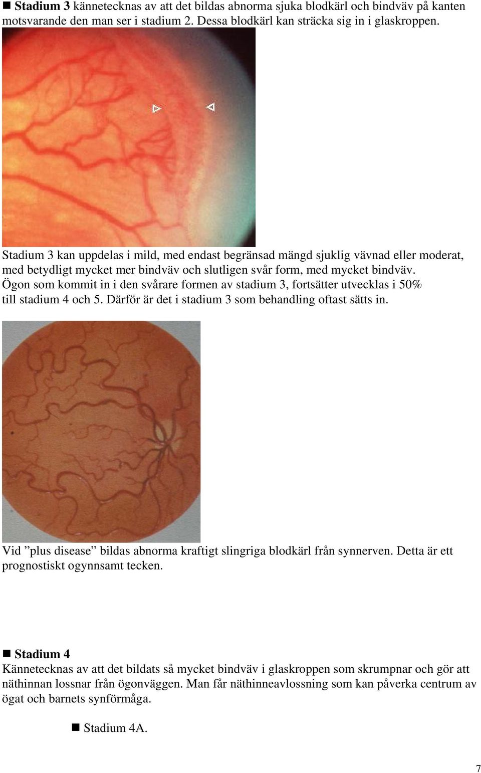 Ögon som kommit in i den svårare formen av stadium 3, fortsätter utvecklas i 50% till stadium 4 och 5. Därför är det i stadium 3 som behandling oftast sätts in.