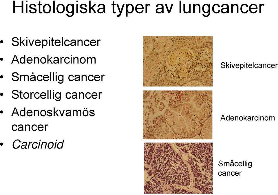 cancer Storcellig cancer Adenoskvamös