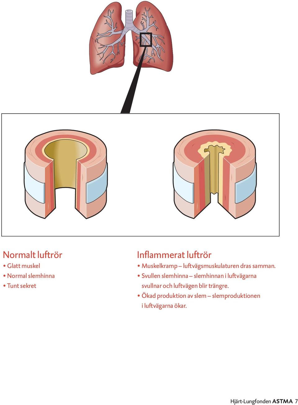 Inflammerat 