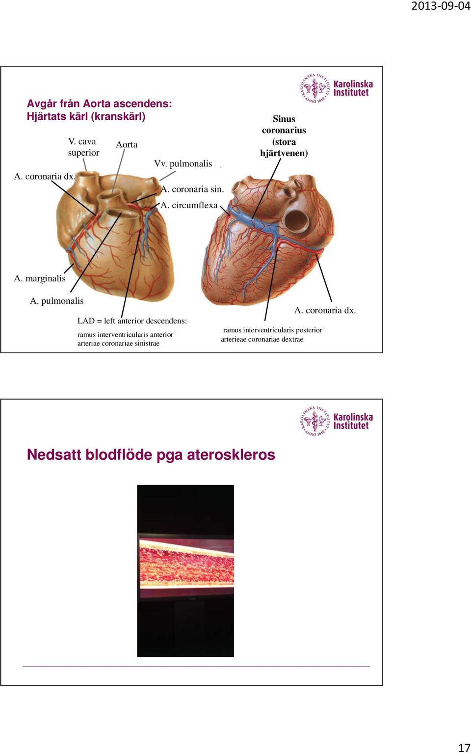 pulmonalis LAD = left anterior descendens: ramus interventricularis anterior arteriae coronariae