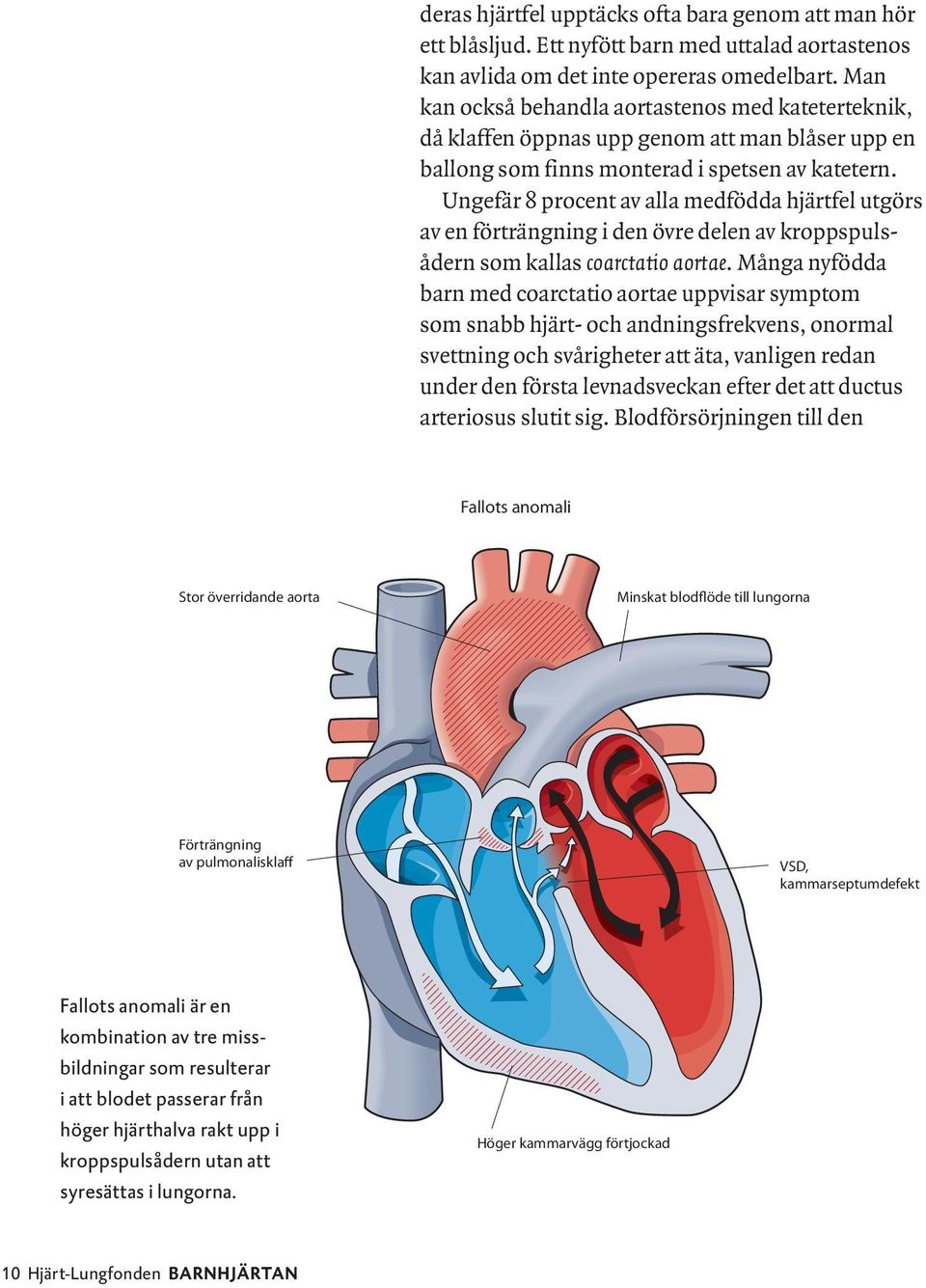 Ungefär 8 procent av alla medfödda hjärtfel utgörs av en förträngning i den övre delen av kroppspulsådern som kallas coarctatio aortae.
