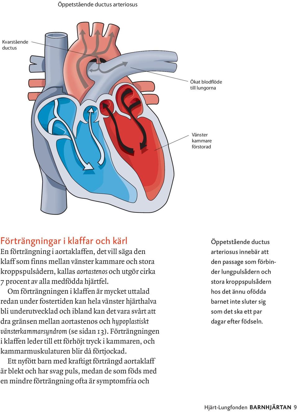 Om förträngningen i klaffen är mycket uttalad redan under fostertiden kan hela vänster hjärthalva bli underutvecklad och ibland kan det vara svårt att dra gränsen mellan aortastenos och hypoplastiskt