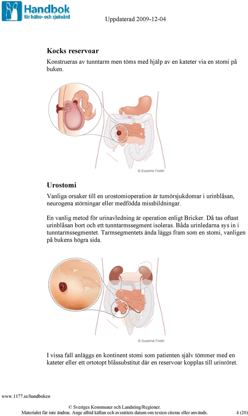 En vanlig metod för urinavledning är operation enligt Bricker. Då tas oftast urinblåsan bort och ett tunntarmssegment isoleras. Båda urinledarna sys in i tunntarmssegmentet.