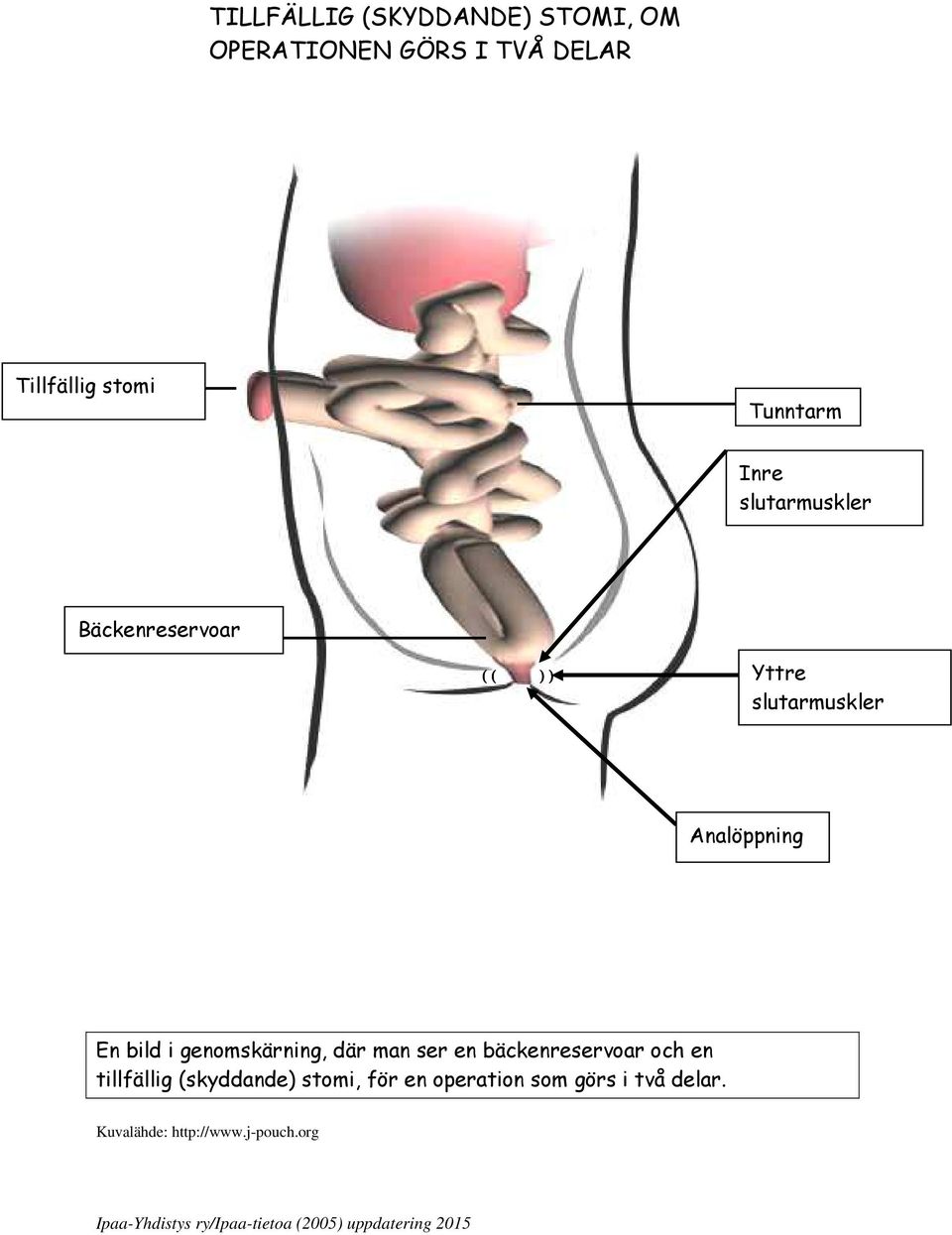 Analöppning En bild i genomskärning, där man ser en bäckenreservoar och en