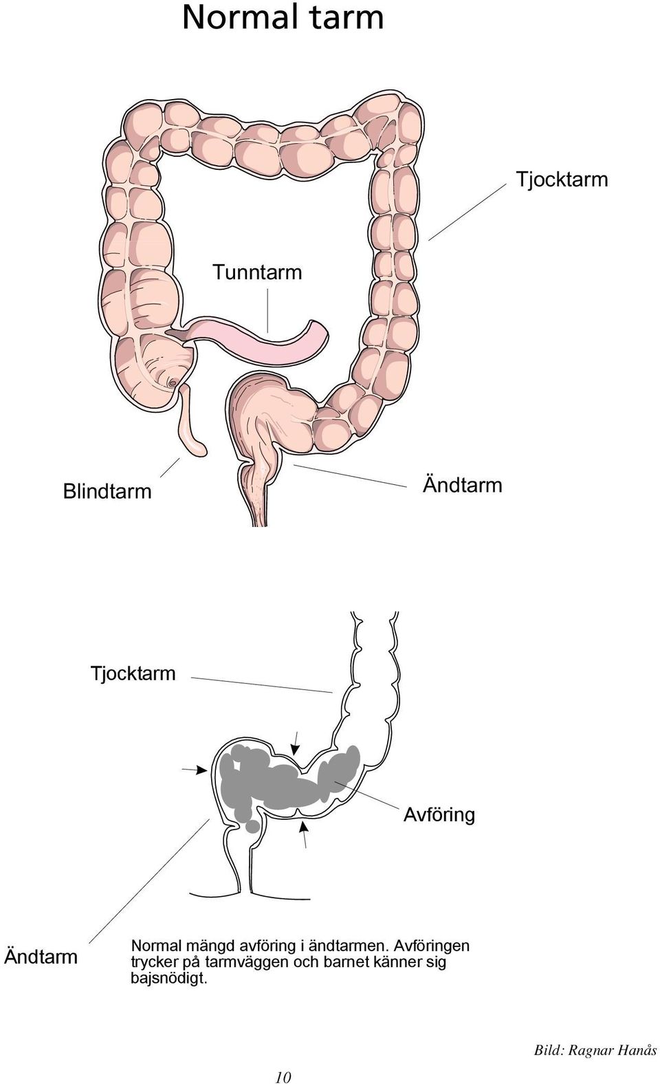Normal tarm Tjocktarm nntarm Avföring Ändtarm Normal mängd avföring i
