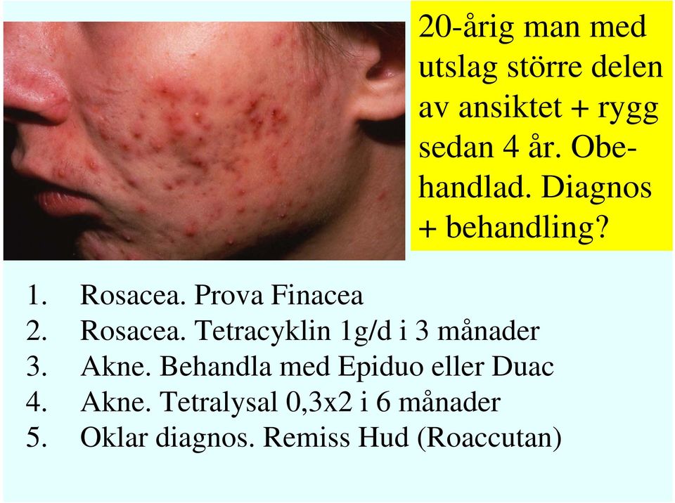 Prova Finacea 2. Rosacea. Tetracyklin 1g/d i 3 månader 3. Akne.