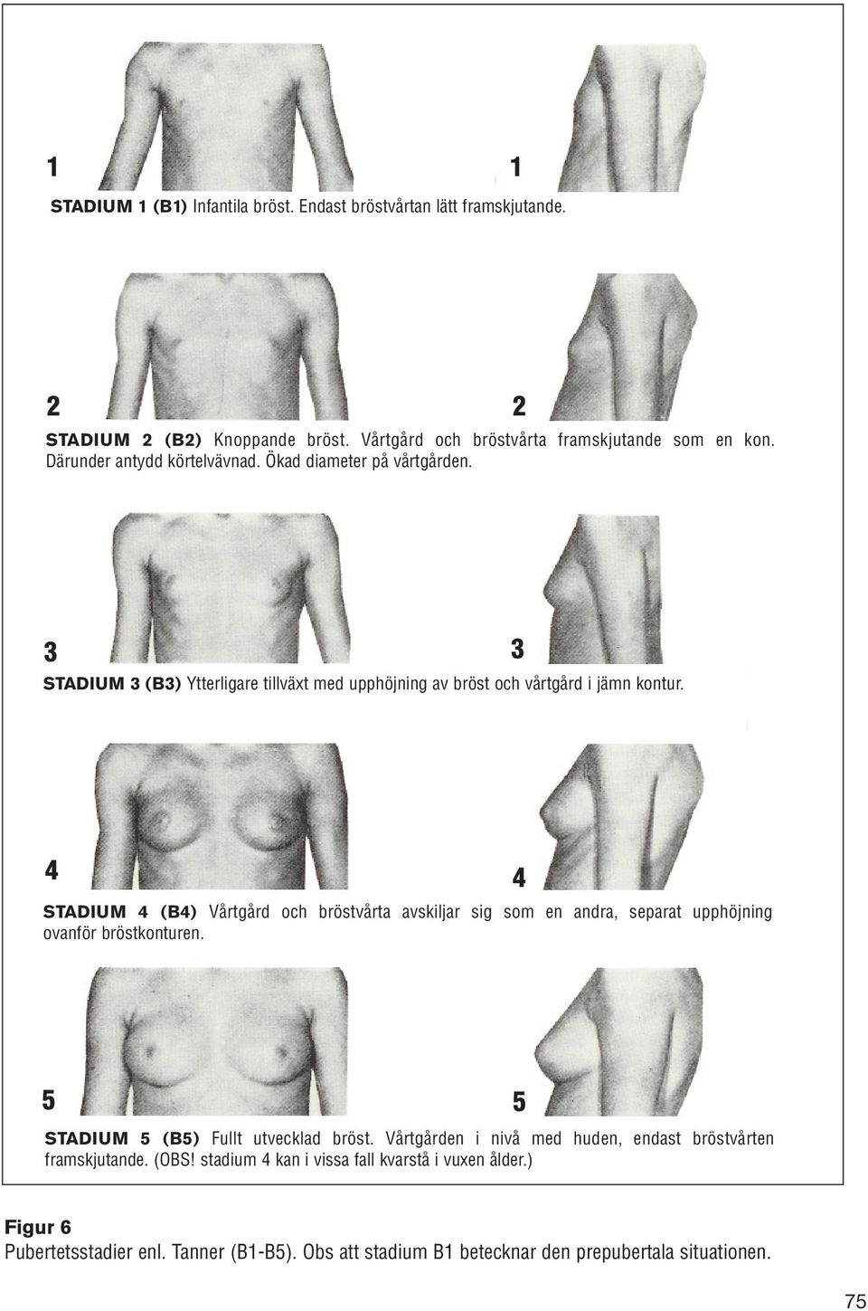 4 STADIUM 4 (B4) Vårtgård och bröstvårta avskiljar sig som en andra, separat upphöjning ovanför bröstkonturen. 4 5 STADIUM 5 (B5) Fullt utvecklad bröst.