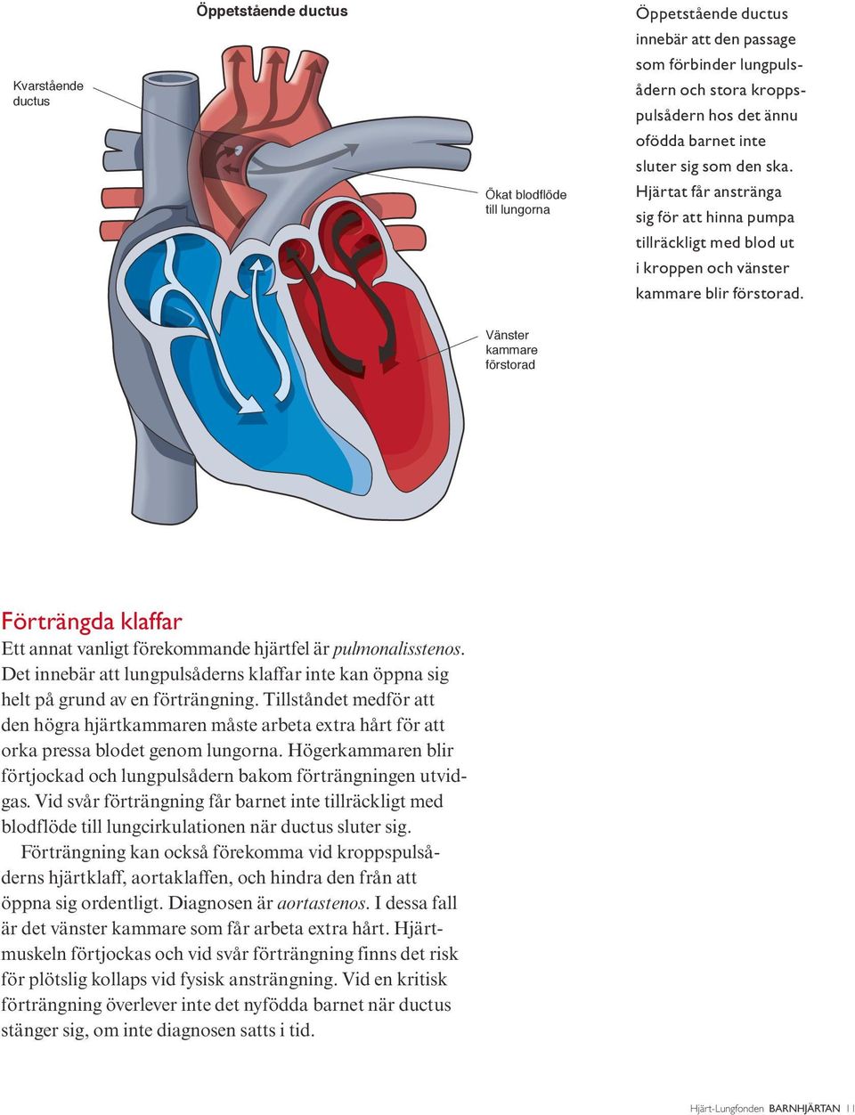 Vänster kammare förstorad Förträngda klaffar Ett annat vanligt förekommande hjärtfel är pulmonalisstenos. Det innebär att lungpulsåderns klaffar inte kan öppna sig helt på grund av en förträngning.