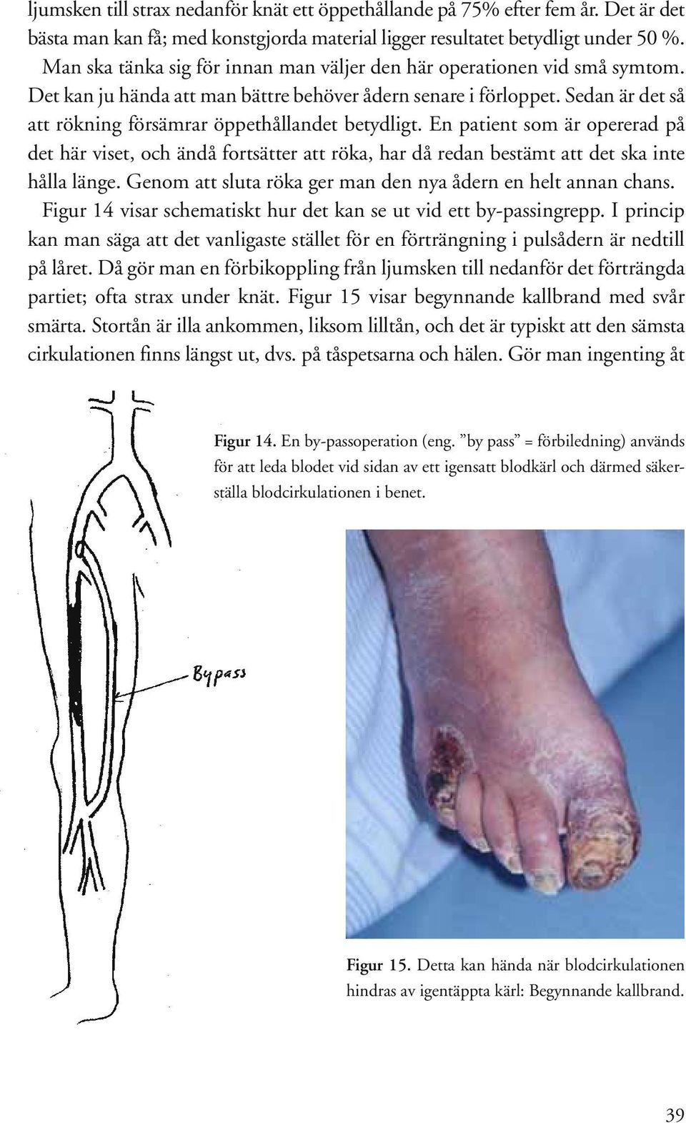 Sedan är det så att rökning försämrar öppethållandet betydligt. En patient som är opererad på det här viset, och ändå fortsätter att röka, har då redan bestämt att det ska inte hålla länge.