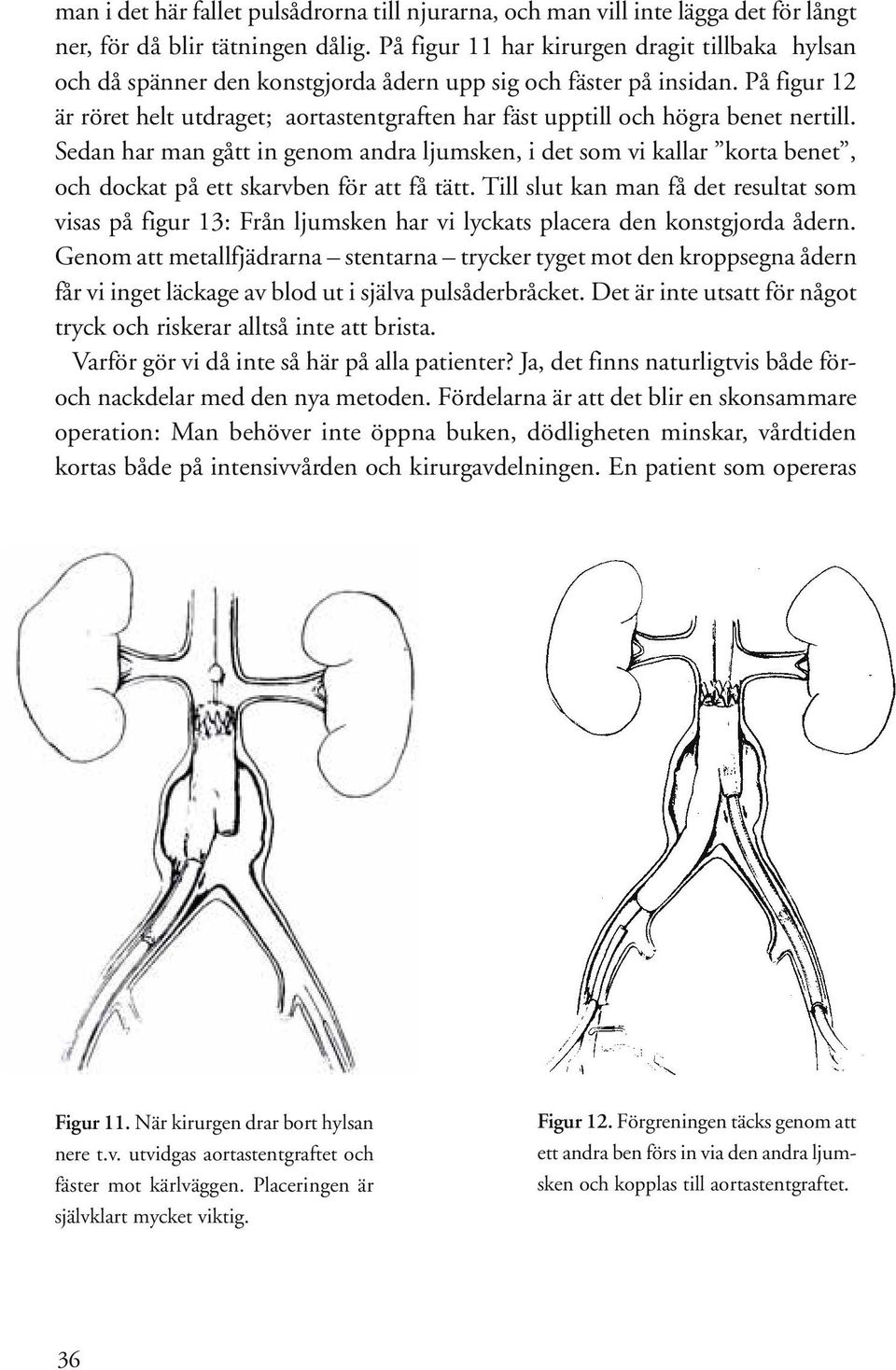 På figur 12 är röret helt utdraget; aortastentgraften har fäst upptill och högra benet nertill.