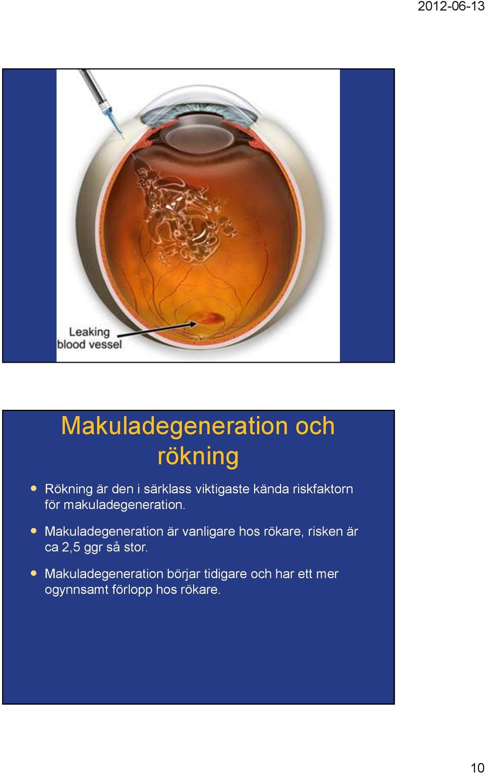 Makuladegeneration är vanligare hos rökare, risken är ca 2,5 ggr