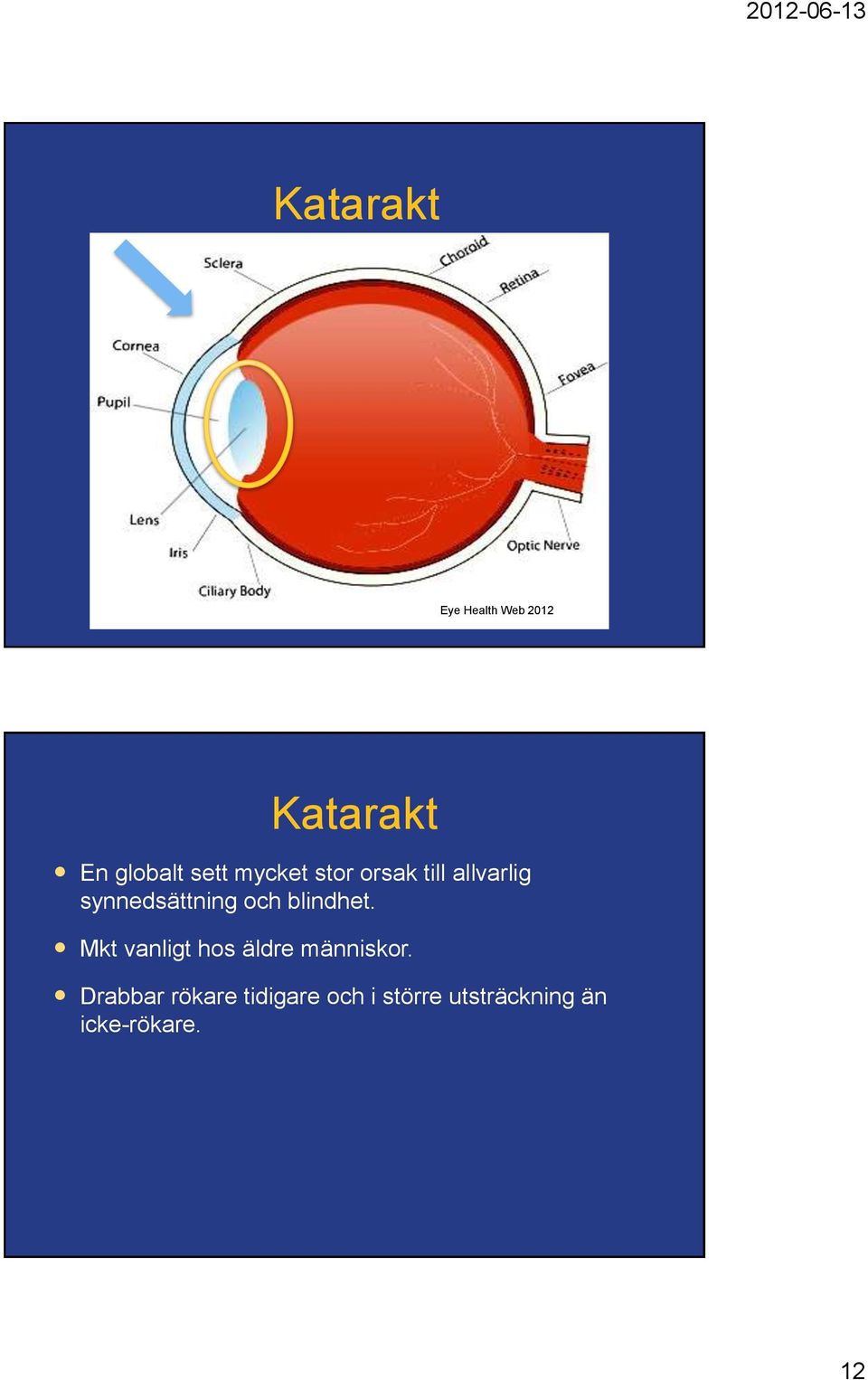 blindhet. Mkt vanligt hos äldre människor.