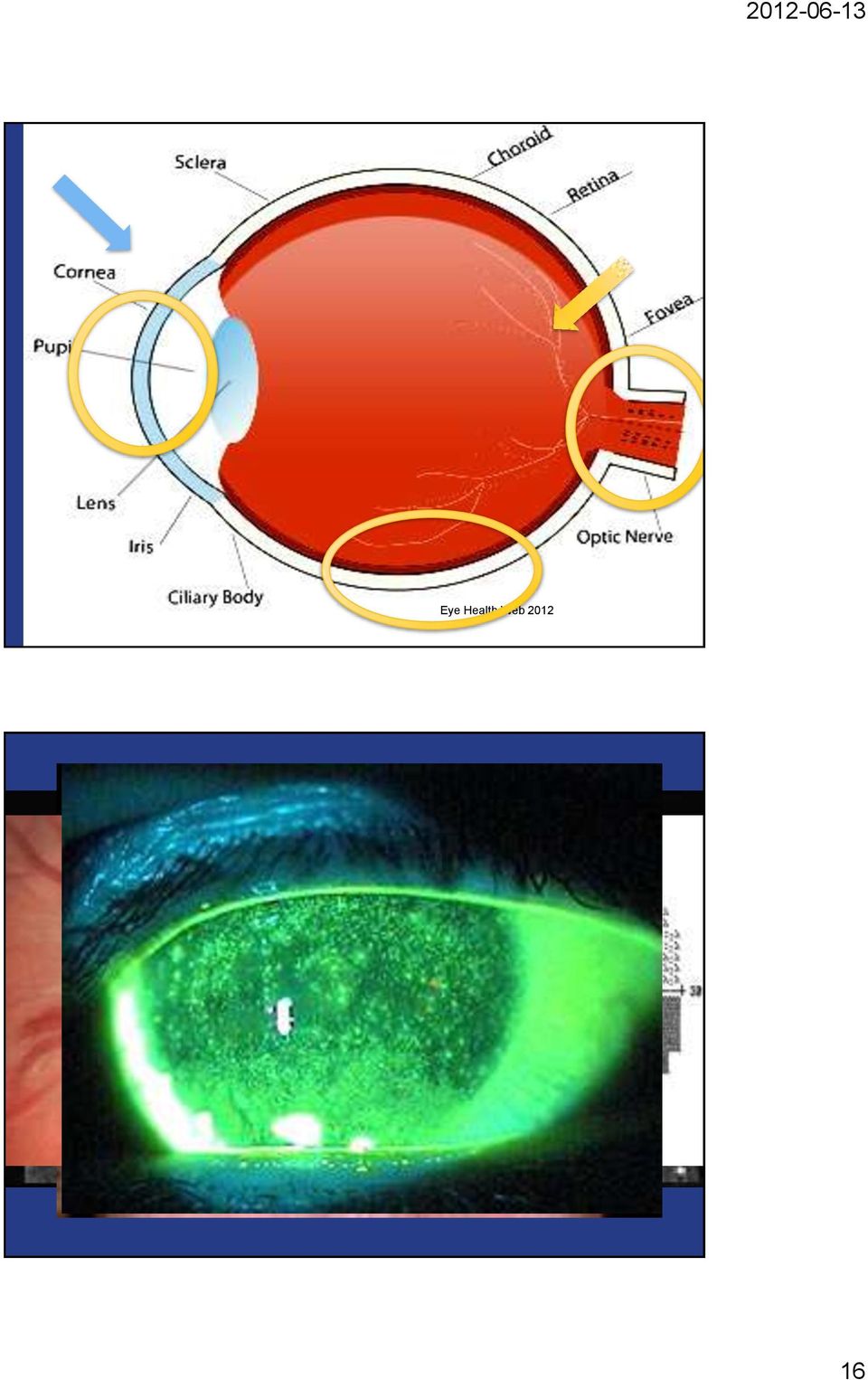 Sjukdomen leder till att ögat blir för stort för ögonhålan så att de poppar ut och fram, vilket kan leda till mekanisk skelning och dubbelseende.