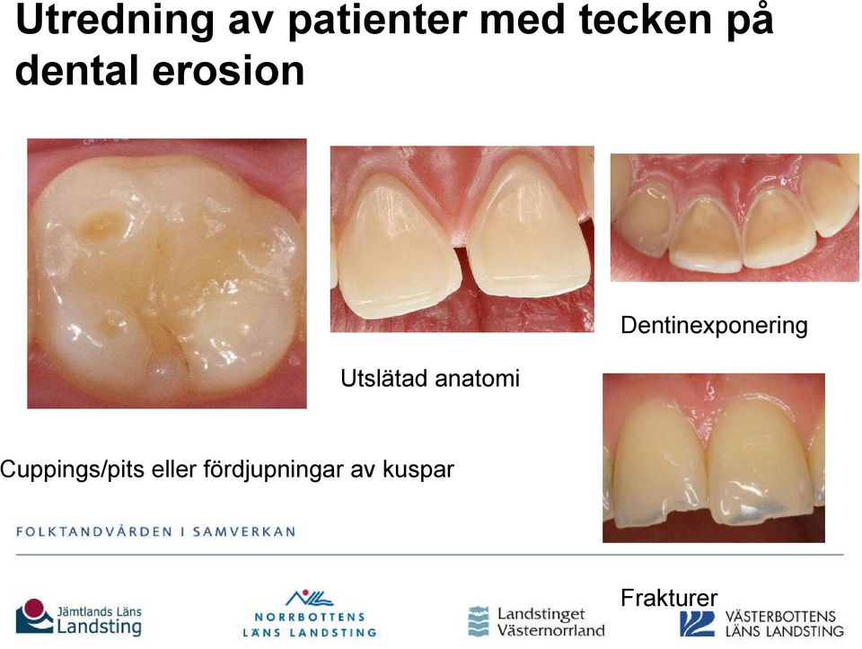 Dentinexponering Cuppings/pits