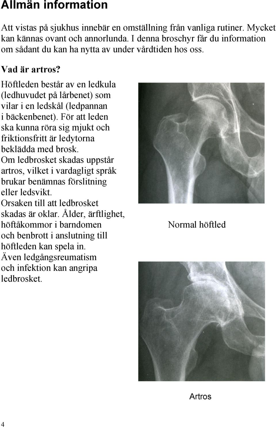 Höftleden består av en ledkula (ledhuvudet på lårbenet) som vilar i en ledskål (ledpannan i bäckenbenet).