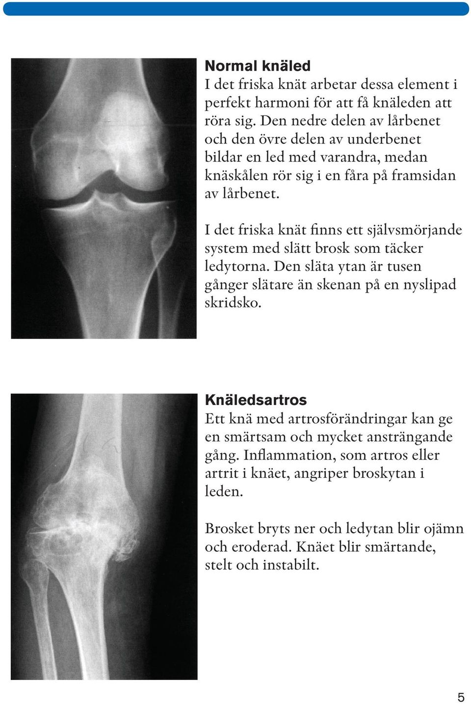 I det friska knät finns ett självsmörjande system med slätt brosk som täcker ledytorna. Den släta ytan är tusen gånger slätare än skenan på en nyslipad skridsko.